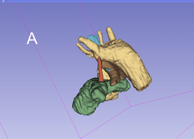 Anomaly of the Embryonic Development of the Aortic Arch