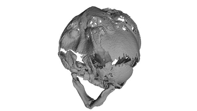 Thumbnail of Craniostenosis Syndrom 2