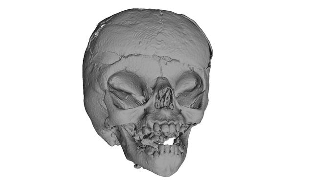 Apert Syndrome after Surgery