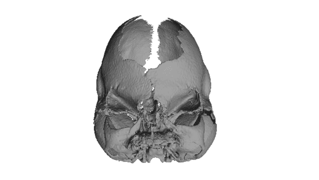 Apert syndrome