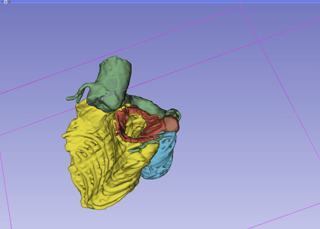 Coronary Artery Fistula